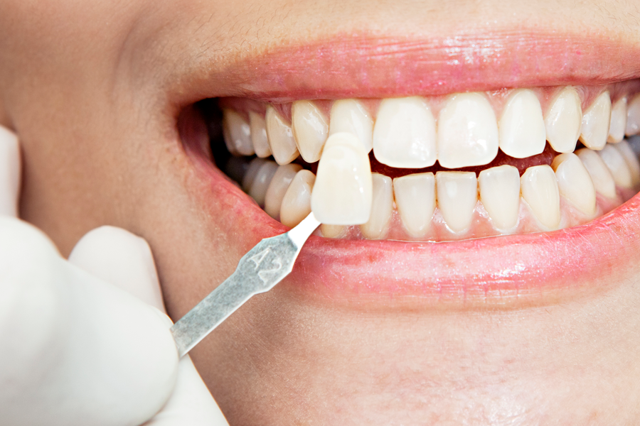 veneers