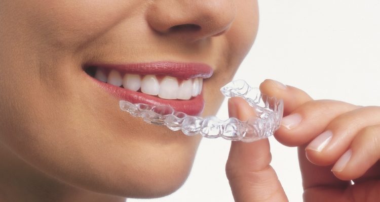invisalign for teeth alignment