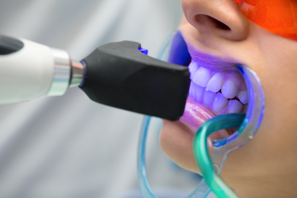 teeth whitening procedure