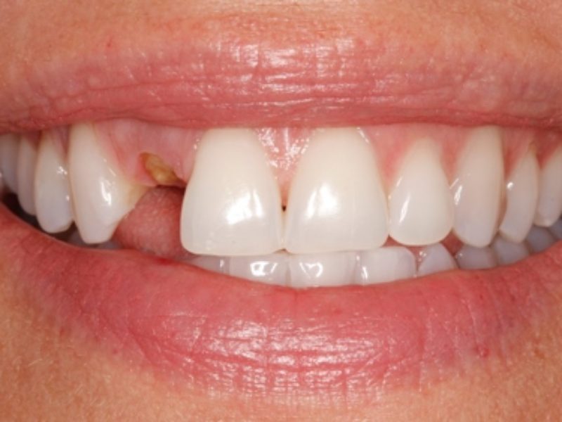 tooth missing